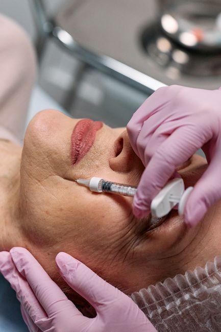 What Is the Best Filler for Marionette Lines? A Friendly Guide to Youthful-Looking Skin